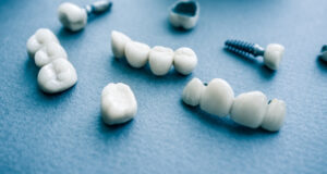 Affordable Dental Implants - How To Find Low Cost Options