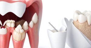 Dental Caries