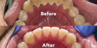 Dental Deep Cleaning: Procedures And Costs