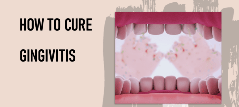 How To Cure Gingivitis