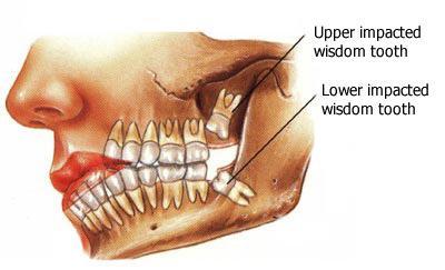 Should I Get My Wisdom Taken Out? Wisdom Teeth Removal Cost And Benefits