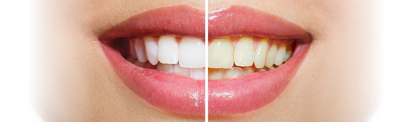 Yellow Teeth - Causes, Home Remedies, And Treatment Options