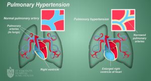 Hypertension Is Linked To Rheumatic Heart Disease