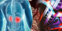 Hypertension And Kidney Health